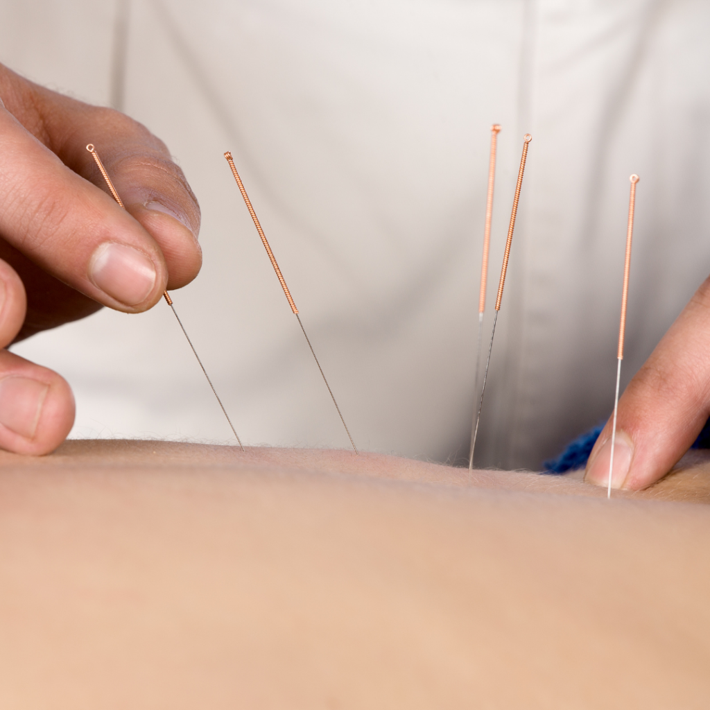 acupuncture